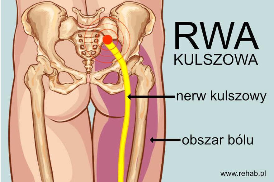 Ćwiczenia na rwę kulszową
