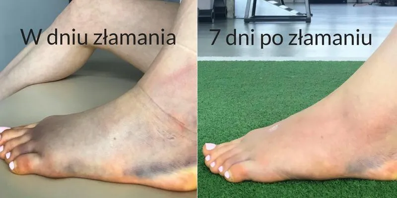 Ćwiczenia po złamaniu kości