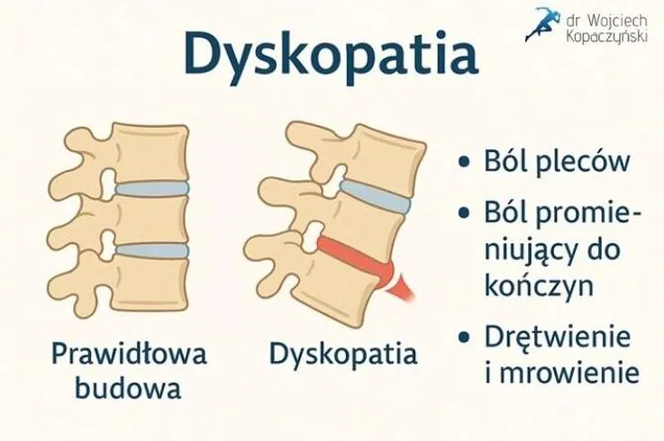 Ćwiczenia przy dyskopatii