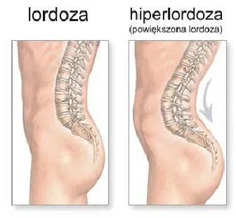 Rehabilitacja lordozy