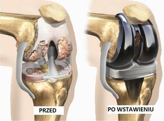 Rehabilitacja po endoprotezie kolana